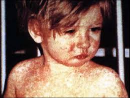 Young child with measles infection
