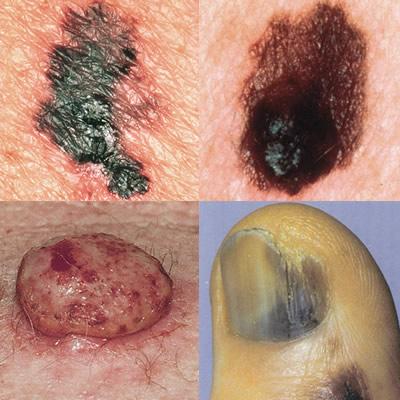 Malignant melanoma is the deadliest form of skin cancer