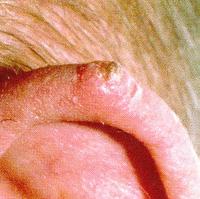 Skin cancer on the ear