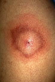 Erythema migrans may be seen early in Lyme disease.