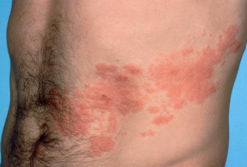 The shingles virus presents as painful blisters on one side of the body.