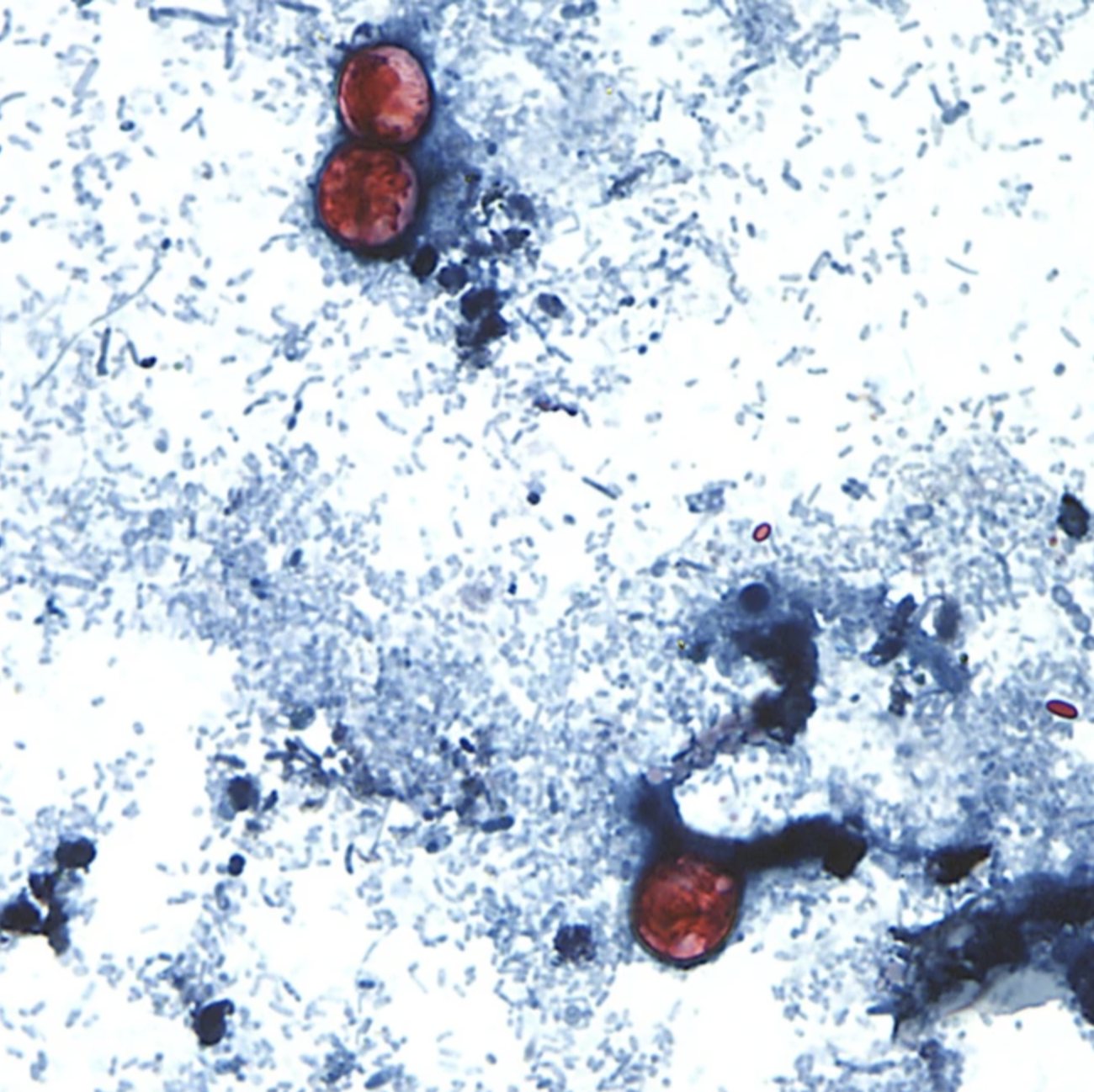 This undated photo taken through a microscope provided by the CDC shows Cyclospora cayetanensis oocysts found in a fresh stool sample which had been prepared with a formalin solution and stained with safranin. (CDC via AP).